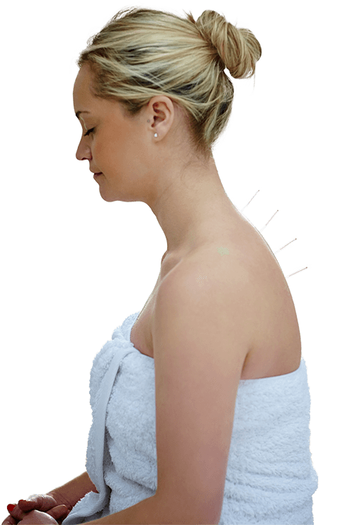 Acupuncture-Treatment.png Acupuncture-Treatment.png