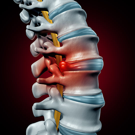 Spinal-Decompression-Pain-Spot.jpg Spinal-Decompression-Pain-Spot.jpg