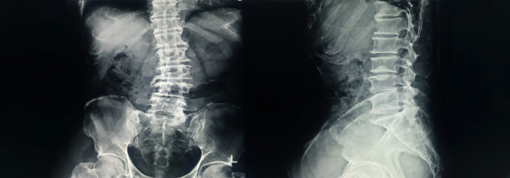 scoliosis care is helped by with chiropractic care