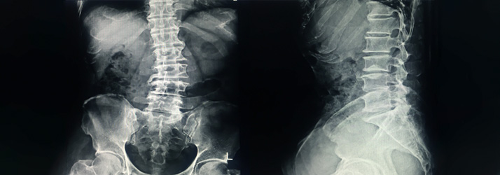Chiropractic-Care-For-Scoliosis.jpg scoliosis care is helped by with chiropractic care