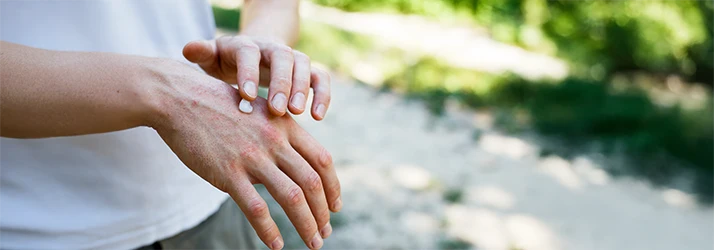 Person applying treatment cream for skin disorder, symbolizing functional medicine relief Person applying treatment cream for skin disorder, symbolizing functional medicine relief