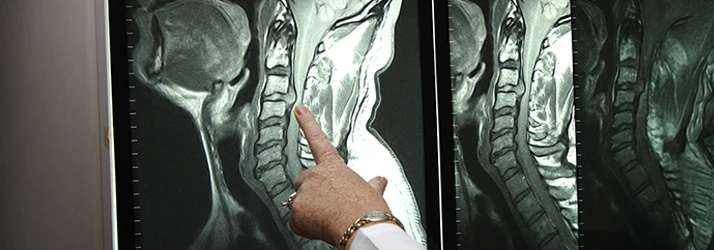 Doctor pointing to cervical spine MRI showing herniated discs Doctor pointing to cervical spine MRI showing herniated discs